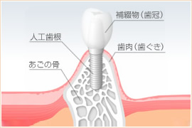 インプラントとはのイメージ